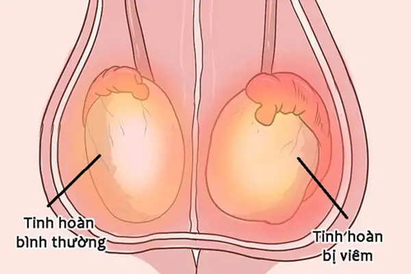 Bệnh lý về tinh hoàn