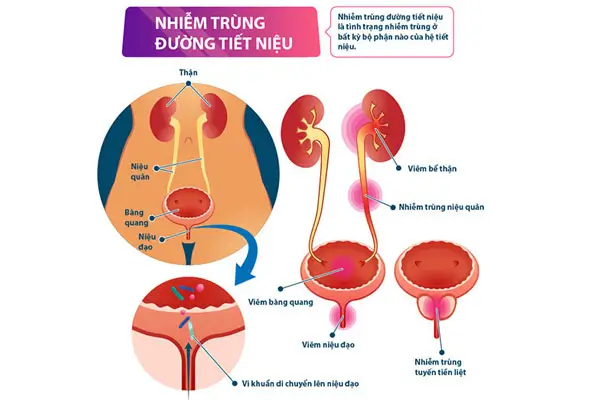Các bệnh lý liên quan đến đường tiết niệu