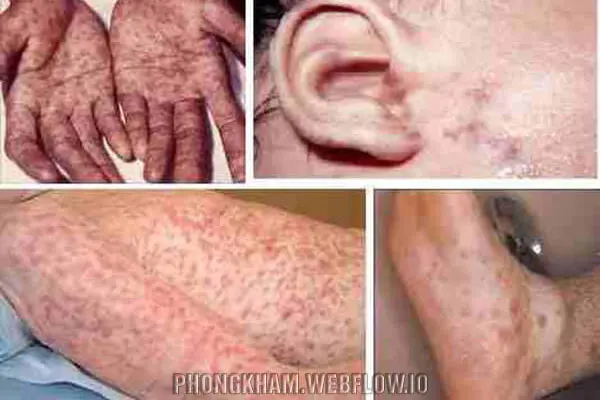 Bệnh giang mai có chữa được không phụ thuộc cơ sở y tế