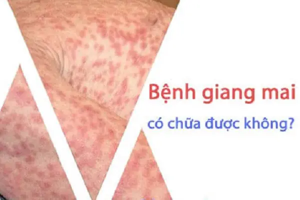Bệnh giang mai có chữa được không? BS Tư Vấn