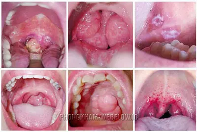 Bệnh giang mai ở miệng, lưỡi Nguyên nhân triệu chứng cách chữa