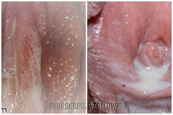 Bệnh lậu ở nữ giới triệu chứng cách chữa bệnh hiệu quả