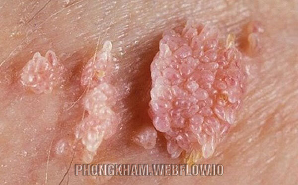 Bệnh sùi mào gà có chữa khỏi hẳn được không