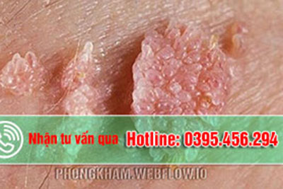 Bệnh sùi mào gà có chữa khỏi hẳn được không