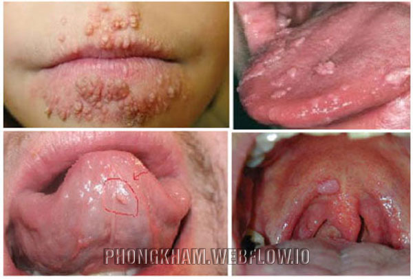 Bệnh sùi mào gà ở lưỡi, môi, họng nguyên nhân cách điều trị