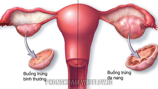 Bệnh buồng trứng đa nang cũng là một trong những bệnh phụ khoa nữ giới thường mắc
