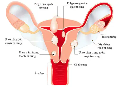 U xơ cổ tử cung bệnh phụ khoa thường gặp