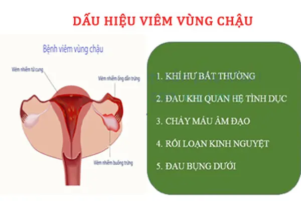 Viêm vùng chậu