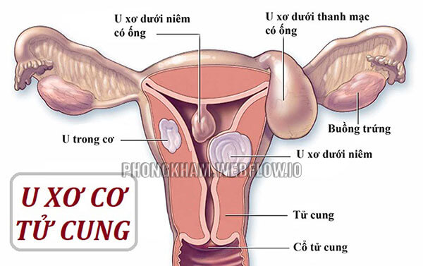 U xơ tử cung cũng là một trong những bệnh phụ khoa nữ giới thường mắc