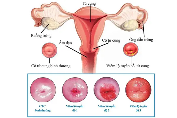Viêm lộ tuyến cổ tử cung bệnh phụ khoa nguy hiểm