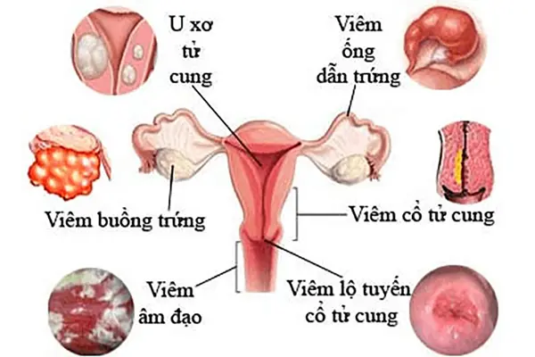 Hình ảnh bệnh phụ khoa