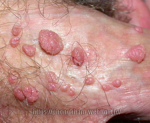 Dấu hiệu bệnh sùi mào gà ở nam giới