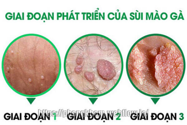 Bệnh sùi mào gà ở nam: dấu hiệu, cách điều trị hiệu quả nhất 2020