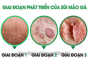 Bệnh sùi mào gà ở nam: dấu hiệu, cách điều trị hiệu quả nhất 2025
