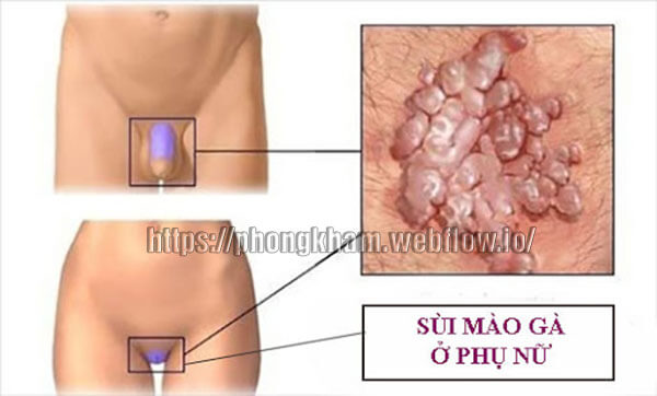 Biểu hiện sùi mào gà ở phụ nữ