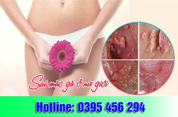 Bệnh sùi mào gà ở phụ nữ: dấu hiệu, cách điều trị hiệu quả