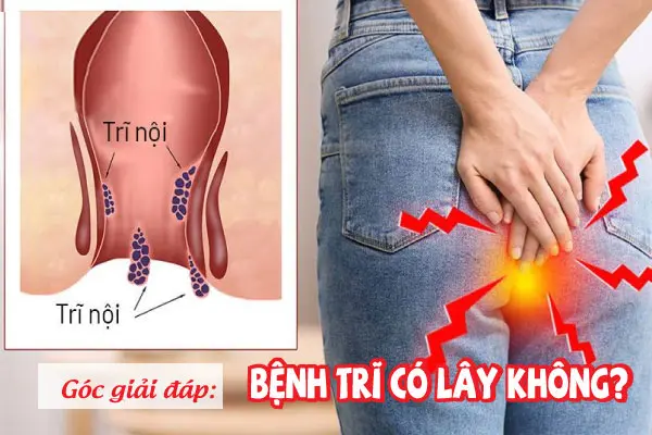 Bệnh trĩ có lây không bác sĩ chuyên khoa giải đáp