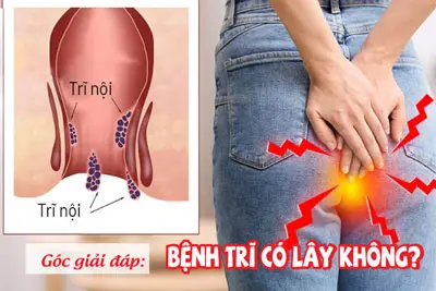 Bệnh trĩ có lây không bác sĩ chuyên khoa giải đáp