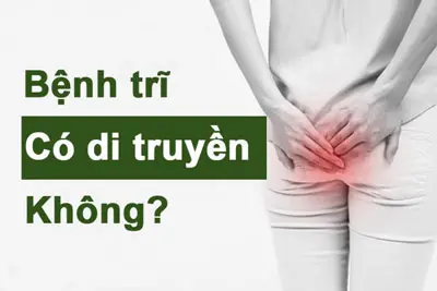 Bệnh Trĩ Có Di Truyền Hay Không? BS Tư vấn