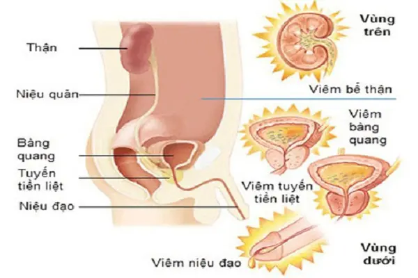 Viêm đường tiết niệu có nguy hiểm không, biến chứng của bệnh