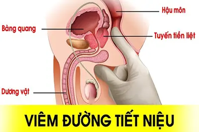 Bệnh viêm đường tiết niệu ở nam và cách điều trị hiệu quả tại nhà