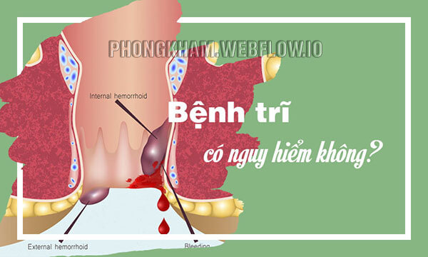 Sự nguy hiểm của bệnh trĩ
