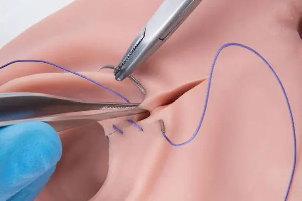 Bị rách vùng kín phải làm sao? BS Trần thị Thành tư vấn