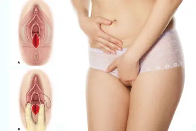 Bị rách da ở vùng kín có sao không phải làm sao?