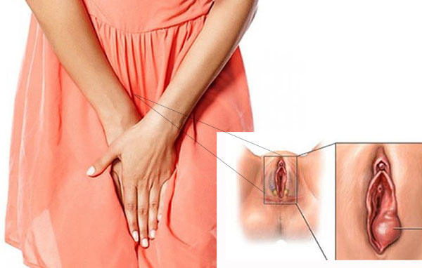 Bị sưng vùng kín (môi lớn, môi bé) nguyên nhân cách khắc phục