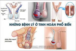 TOP 7 bệnh tinh hoàn thường gặp triệu chứng nguyên nhân