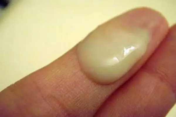 Đặc điểm và nguyên nhân âm đạo ra khí hư màu xanh