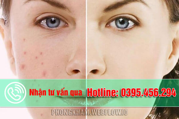 11 Cách trị thâm mụn bằng phương pháp tự nhiên tại nhà hiệu quả