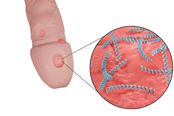 Hình ảnh quy đầu bị nổi mẩn đỏ do giang mai