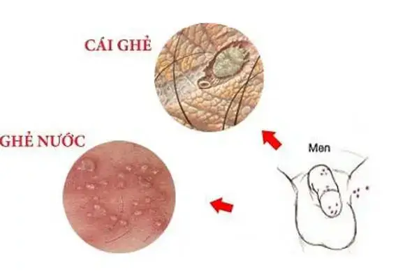 Hình ảnh quy đầu bị nổi mẩn đỏ do ghẻ sinh dục