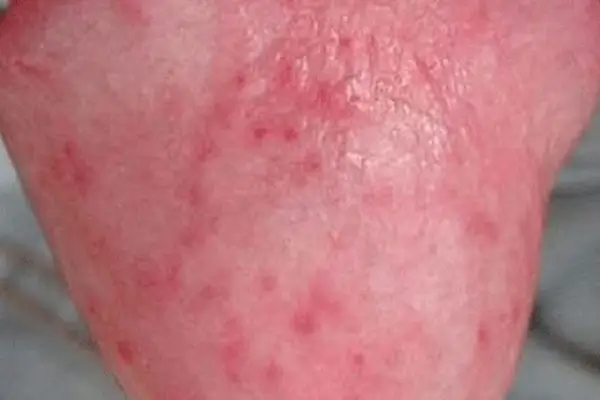 Tình trạng cậu nhỏ bị nổi mẩn đỏ là như thế nào?