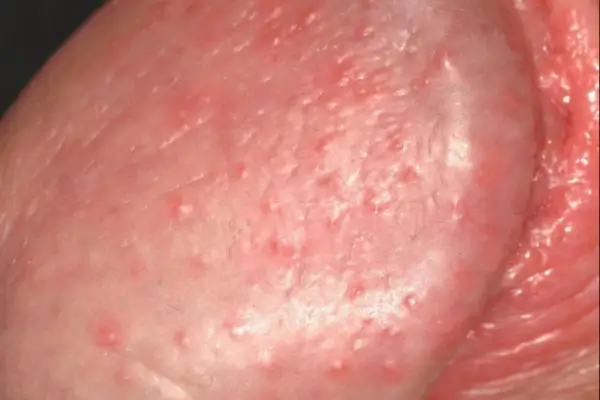 Cách điều trị quy đầu bị nổi mẩn đỏ