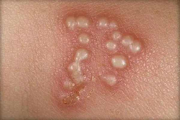 Hình ảnh quy đầu bị nổi mẩn đỏ do mụn rộp sinh dục