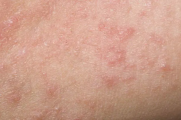 Hình ảnh quy đầu bị nổi mẩn đỏ do Viêm da tiếp xúc