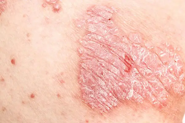 Hình ảnh quy đầu bị nổi mẩn đỏ do vảy nến vùng kín