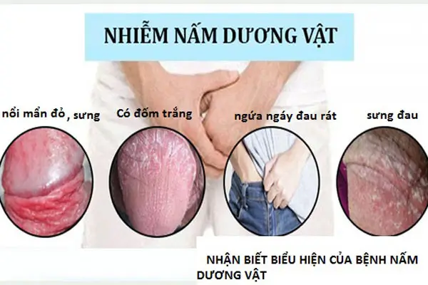 Hình ảnh quy đầu bị nổi mẩn đỏ do nấm cannida