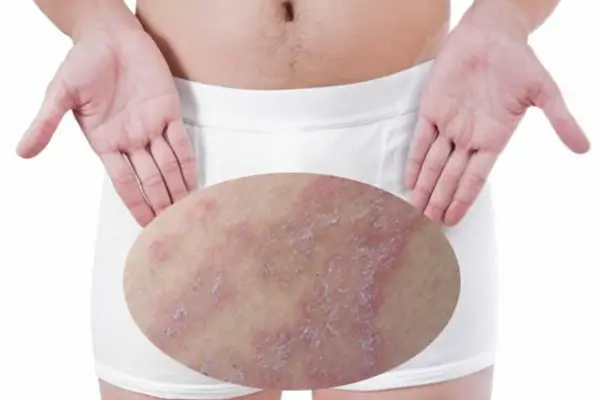 Hình ảnh quy đầu bị nổi mẩn đỏ do chàm bìu