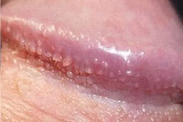 Hình ảnh quy đầu bị nổi mẩn đỏ do Chuỗi hạt ngọc dương vật