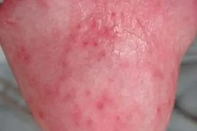 Cậu nhỏ quy đầu bị nổi mẩn đỏ nguyên nhân cách điều trị HÌNH ẢNH