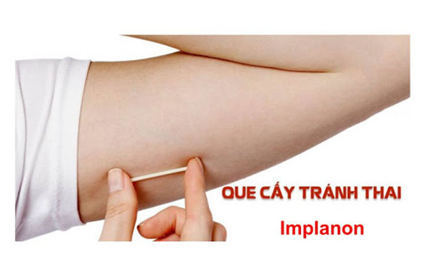 Cấy que tránh thai như thế nào cấy ở đâu tốt an toàn và hiệu quả