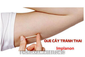 Cấy que tránh thai như thế nào cấy ở đâu tốt an toàn và hiệu quả
