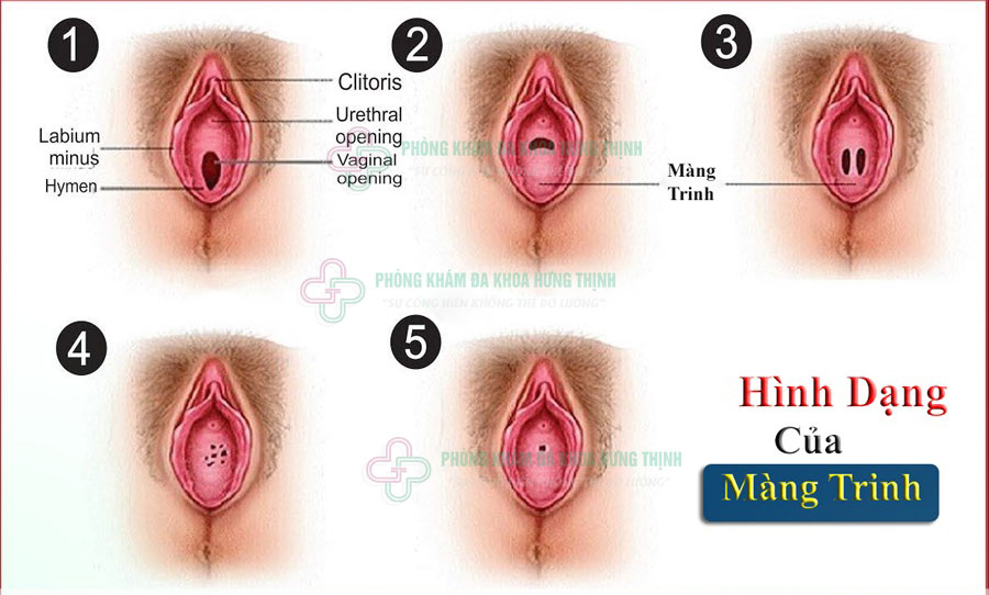 Hình ảnh màng trinh thật của con gái chưa rách và đã rách
