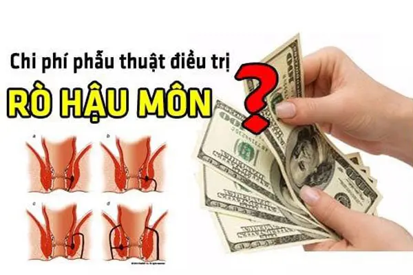 Chi phí phẫu thuật rò hậu môn hết bao nhiêu tiền giá mổ 2025