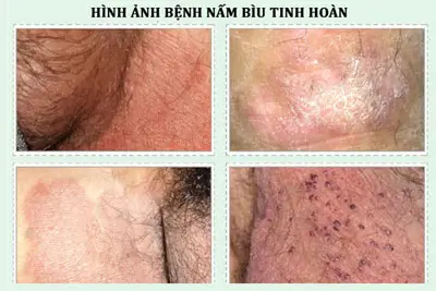 Chữa bệnh nấm bìu an toàn hiệu quả tại nhà 2025