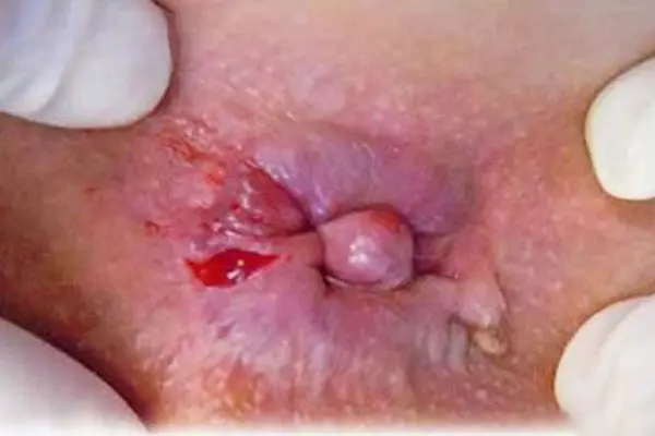  Hình ảnh và dấu hiệu bệnh trĩ nhẹ cơ năng