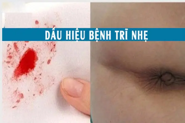 Dấu hiệu bệnh trĩ nhẹ có hình ảnh nhận biết